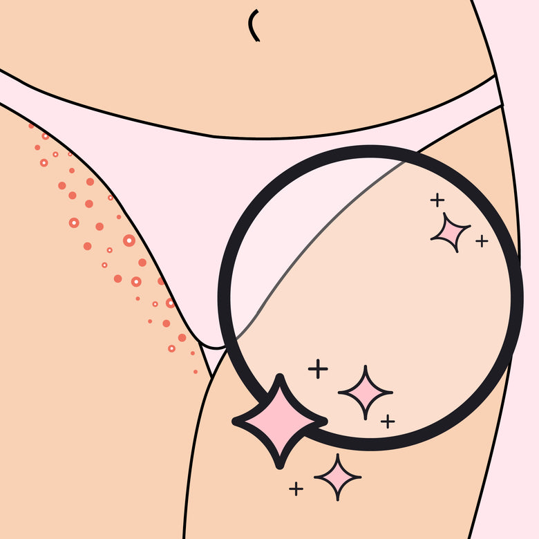 illustration depicting the results of an effective bikini line razor bump remedy