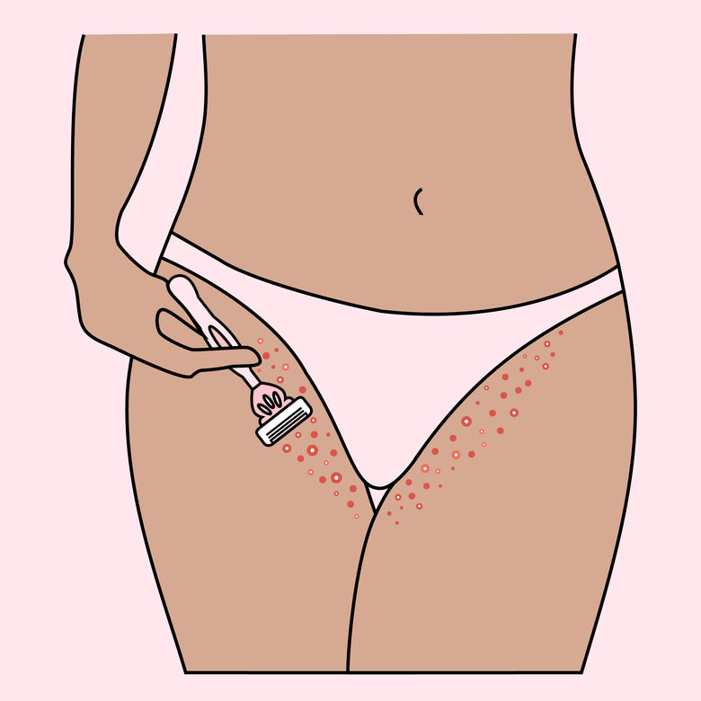 illustration depicting bikini line razor bumps