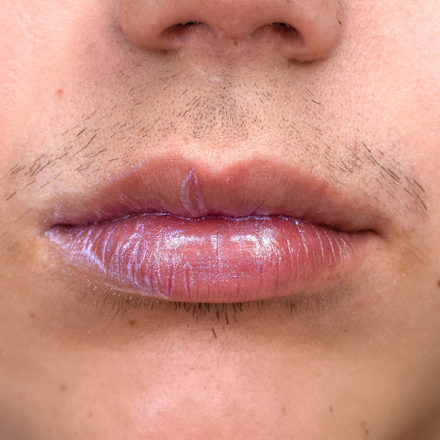 Why Does PCOS Cause Excessive Facial Hair Growth?